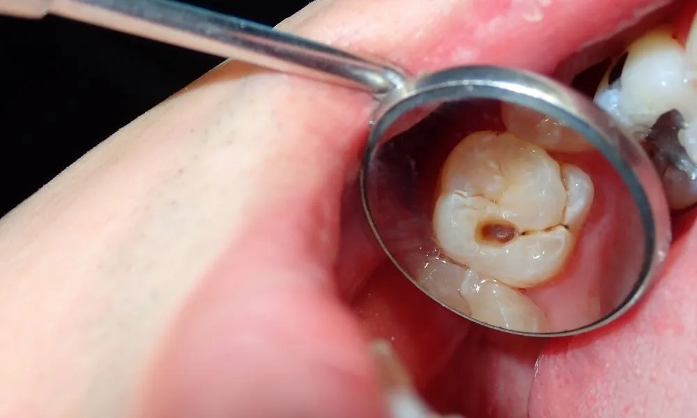 Tooth Erosion